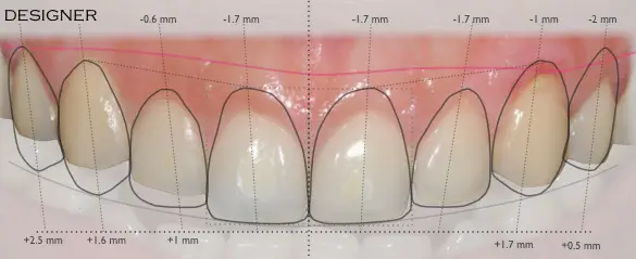 Diseño digital de sonrisa en Dr. G Dental Studio Miami