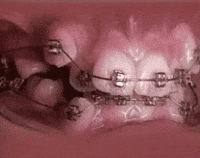 Transformación de sonrisa con aparatos de ortodoncia, Dr. G Dental Studio Miami